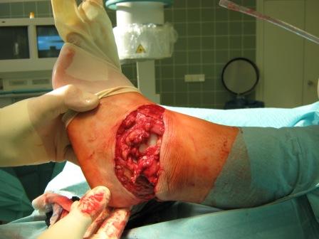 Saegeverletzung2 OSG,27.05.09.JPG