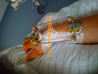 IMG_0582_externer Fixateurklw.jpg